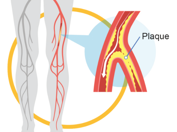 Understanding Peripheral Vascular Disease Causes Symptoms, and Treatment